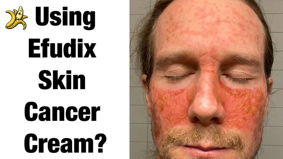 My Experience with Efudix Skin Cancer Cream